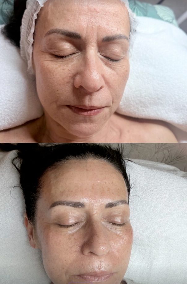 Antes y después de un tratamiento facial en LP Beauty Studio