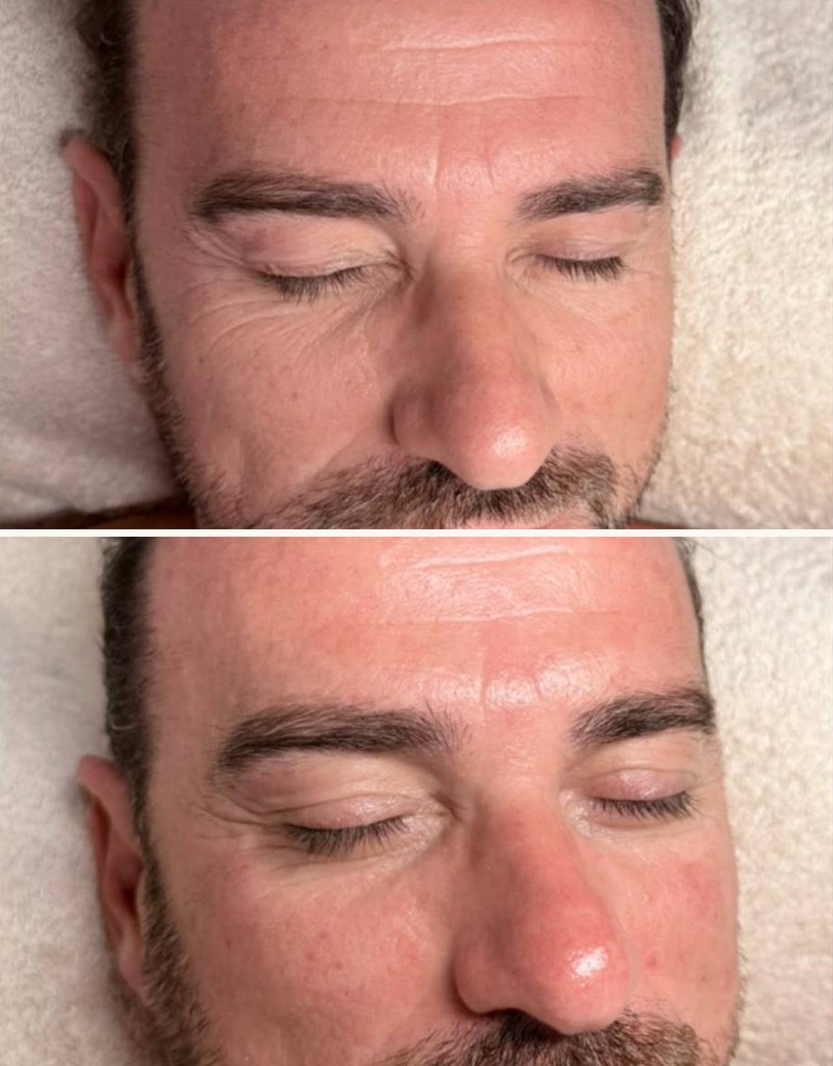 Antes y después de un tratamiento facial en LP Beauty Studio